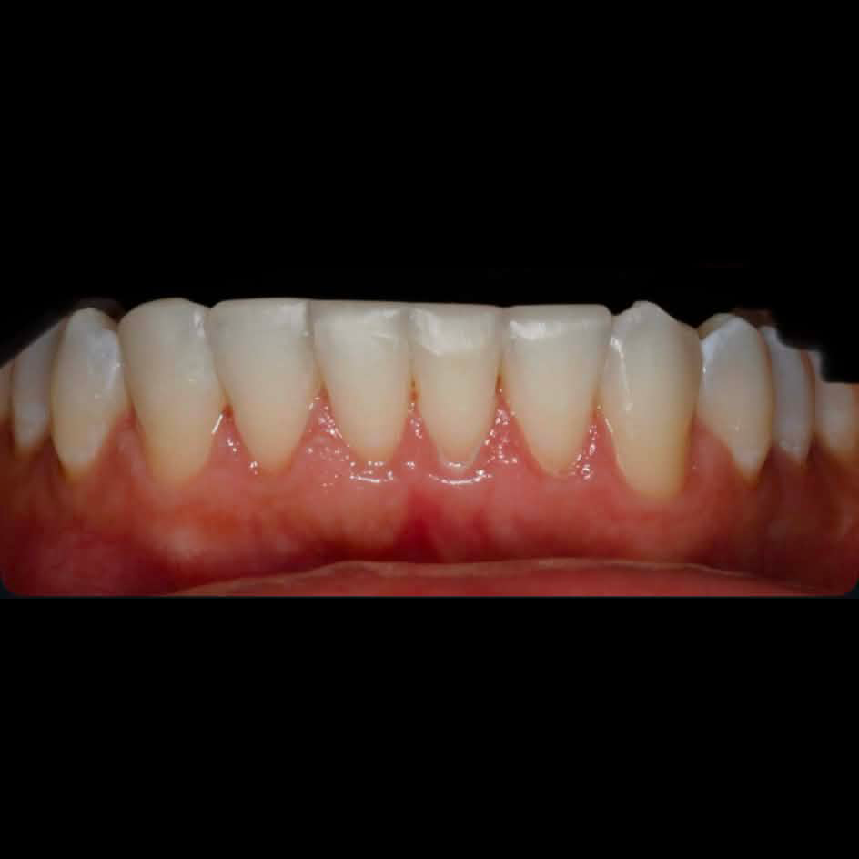 After composite bonding
