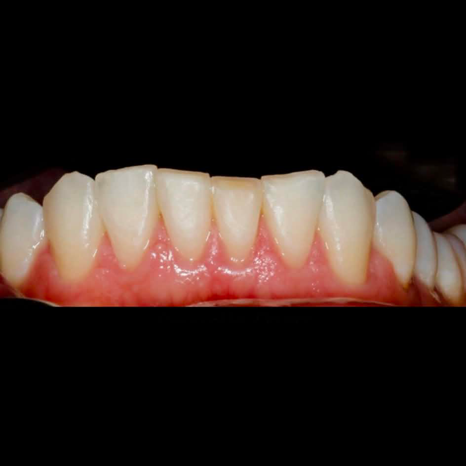 Before composite bonding
